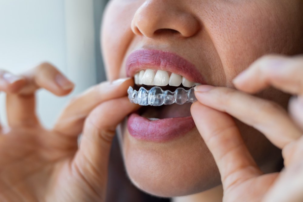 How to Prepare for Your Invisalign® Treatment